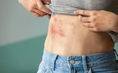 Le zona peut-il cacher un cancer ?
